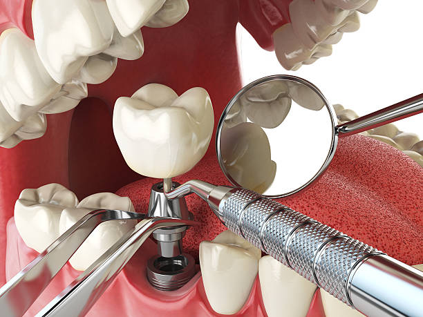 Best Emergency Wisdom Tooth Extraction in Cuyahoga Falls, OH